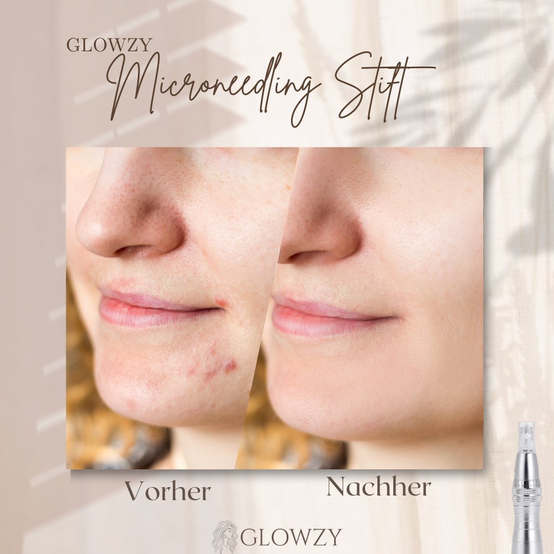 GLOWZY - LED Microneedling-Stift