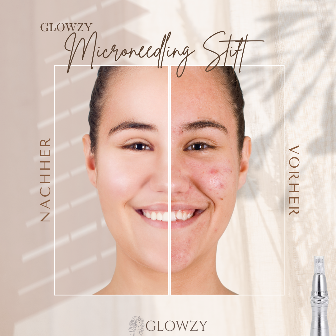 GLOWZY - LED Microneedling-Stift